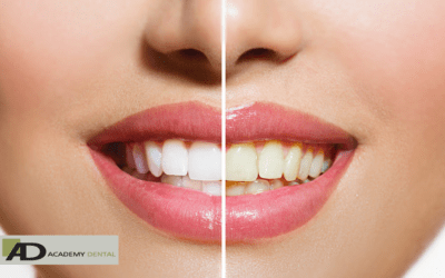 Tips to Prevent Tooth Discoloration After Teeth Whitening