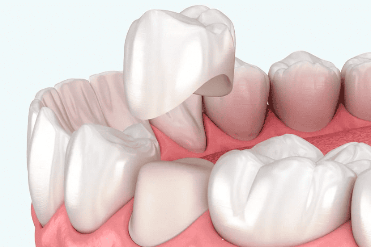 tooth structure required to get dental crowns