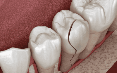 How to Fix A Chipped Tooth: Your Cosmetic Dentistry Options