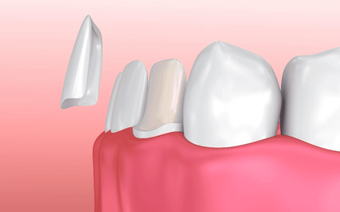 long term caring tips for veneers