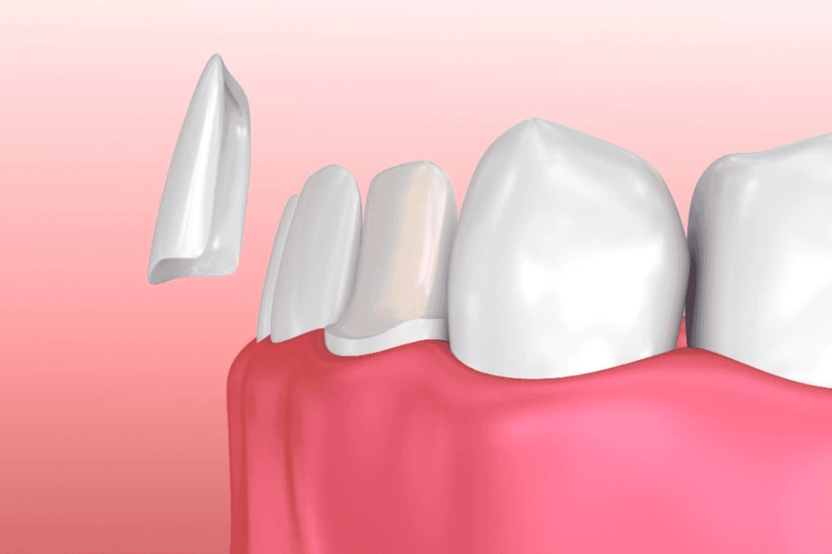 long term caring tips for veneers