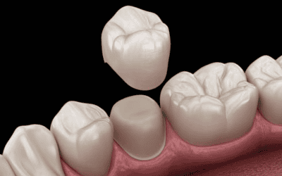 What To Expect With CEREC One-Visit Restorations
