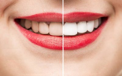 Can Teeth Whitening Damage Your Enamel?