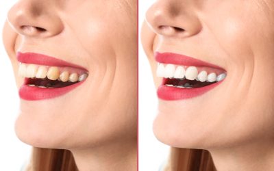 The Role of Stains and Discoloration in Teeth Whitening Effectiveness