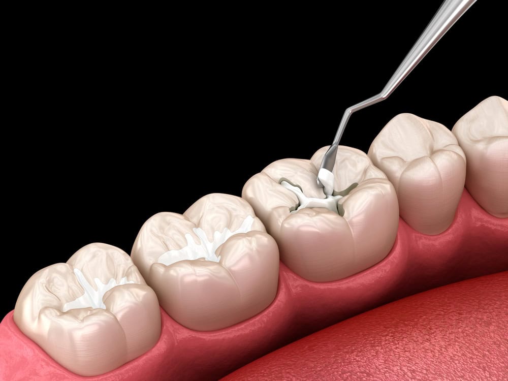 root canal vs filling: how to know the difference