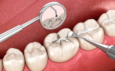 Composite vs. Amalgam Fillings: What’s the Difference?