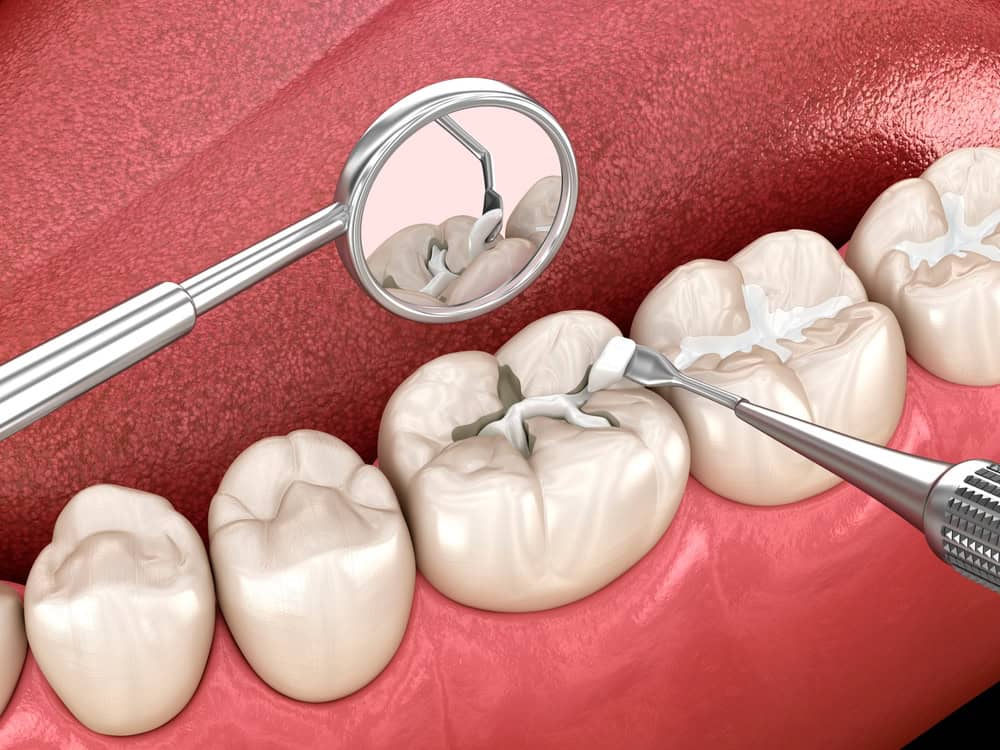 composite vs amalgam fillings what's the difference