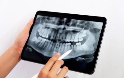 What Can Digital Dental X-Rays Detect That a Visual Exam Can’t?