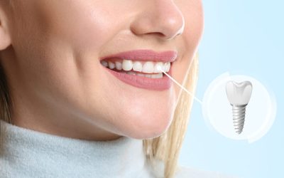 Does Dental Coverage Include Implants and Crowns?